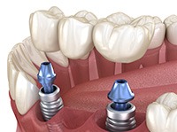 Illustration of an implant bridge