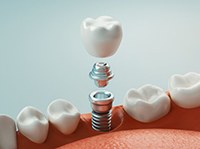 single dental implant with a crown replacing a missing tooth 