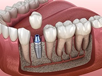 dental implant being placed in the lower jaw 