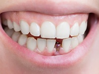 dental implant being placed in the lower jaw 