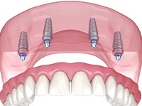 Illustration of an implant denture