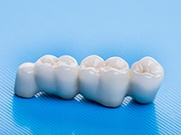 A dental bridge