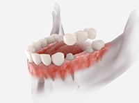 a CGI image of a dental bridge on a jaw
