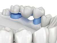 A traditional dental bridge