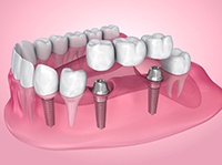 A dental implant bridge