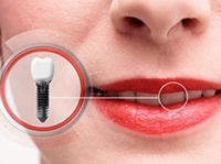 close-up of a woman smiling with a dental implant crown