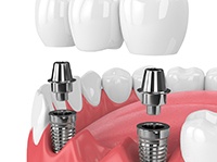 two dental implant posts supporting a dental bridge