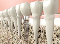 Digital illustration of dental implant