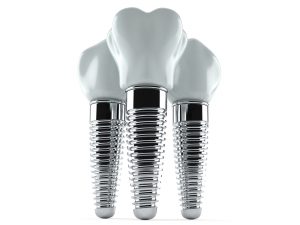 Three dental implants