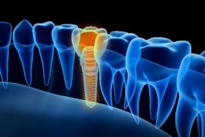 Digital representation of dental implant
