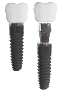 two dental implants