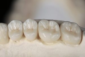 dental crowns on a model of a mouth