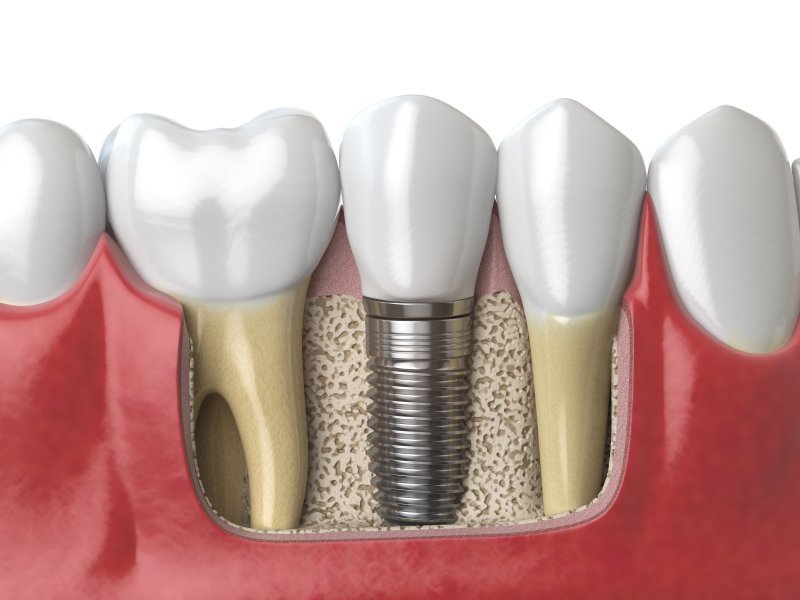 Dental implant illustration