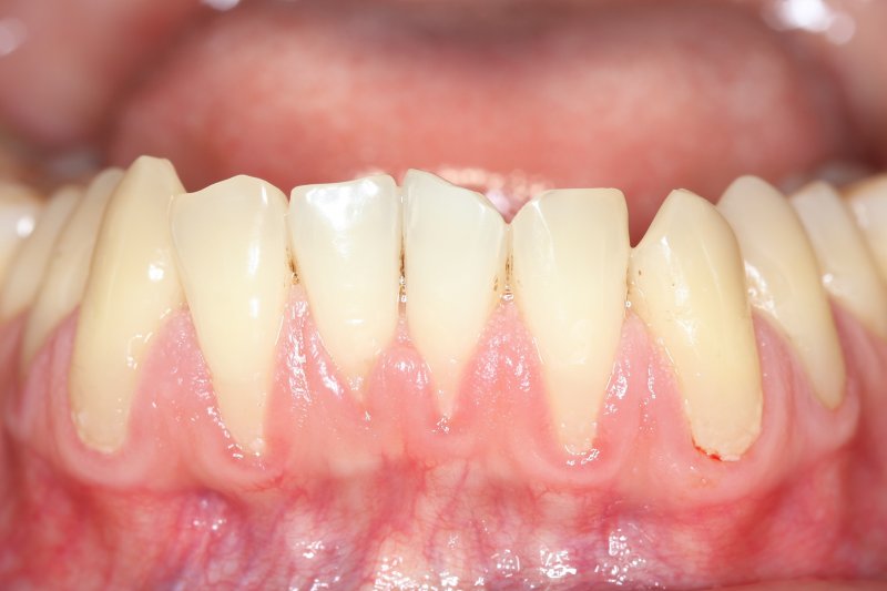 Gums growing over back tooth deals